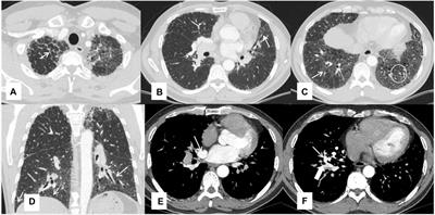 Case report: Fibrotic interstitial lung disease as the initial manifestation of hereditary pulmonary alveolar proteinosis caused by CSF2RB mutation